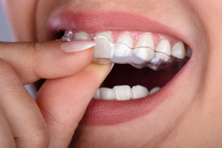 Patient smiling with aligners